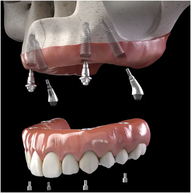 All On X Dental Implants Vista