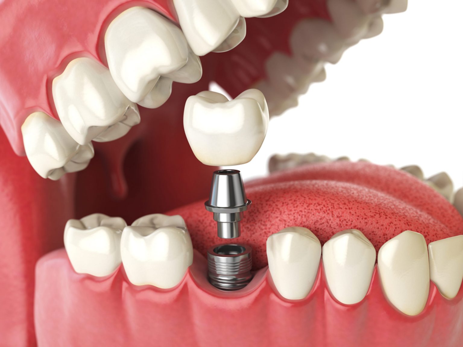 Best Dental Implants Vista