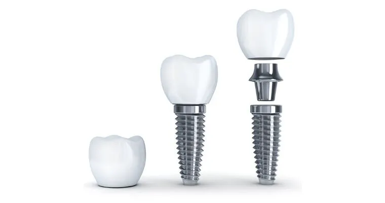 Dental Implants Cost Carlsbad