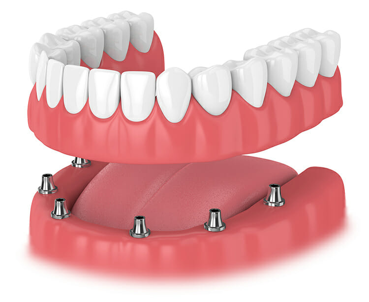 Denture Dental Implants Carlsbad