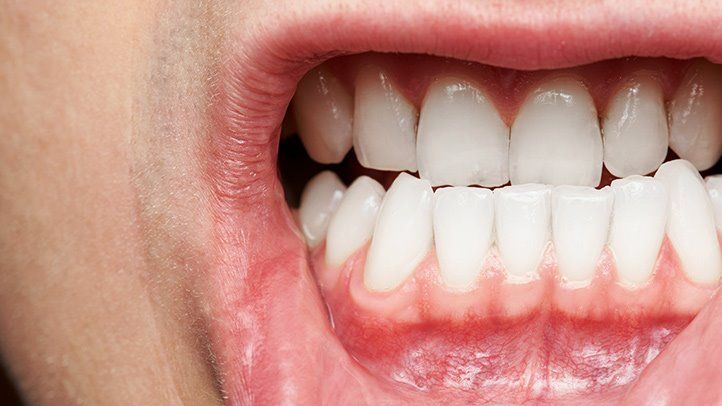 Gum Disease Symptoms Carlsbad