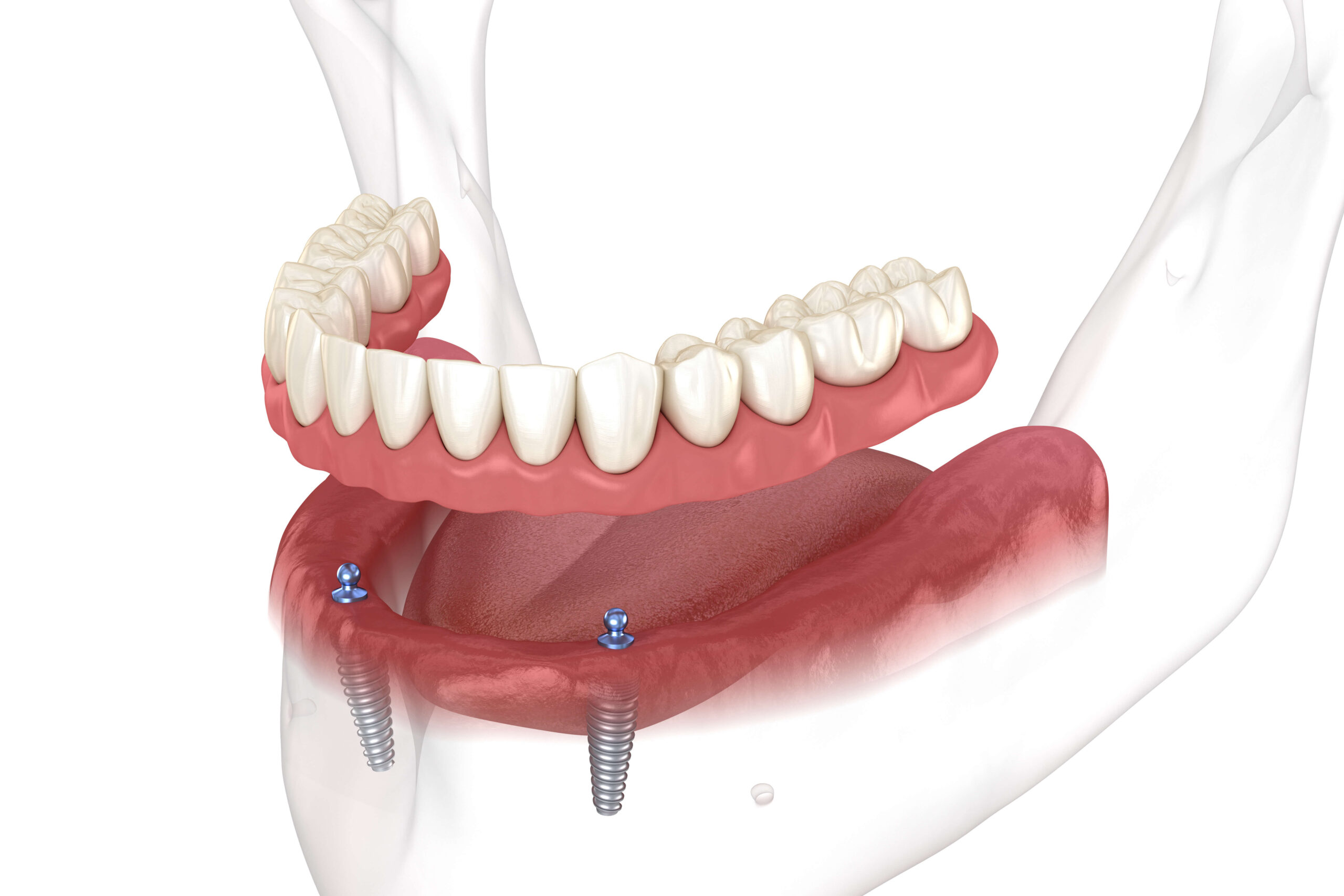 Implant Supported Dentures Oceanside