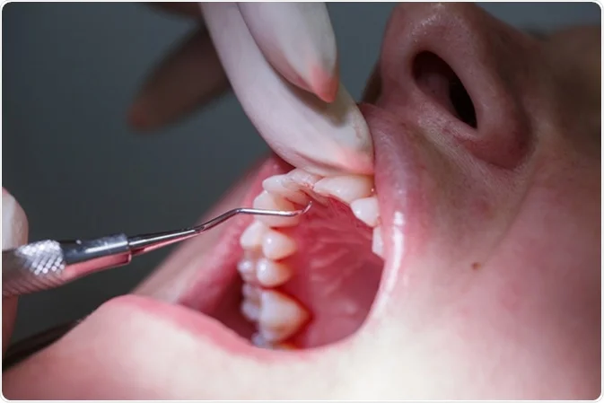 Periodontal Disease Causes Carlsbad