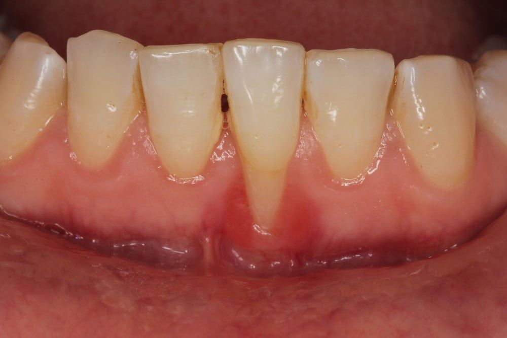 Periodontal Disease Treatment Oceanside