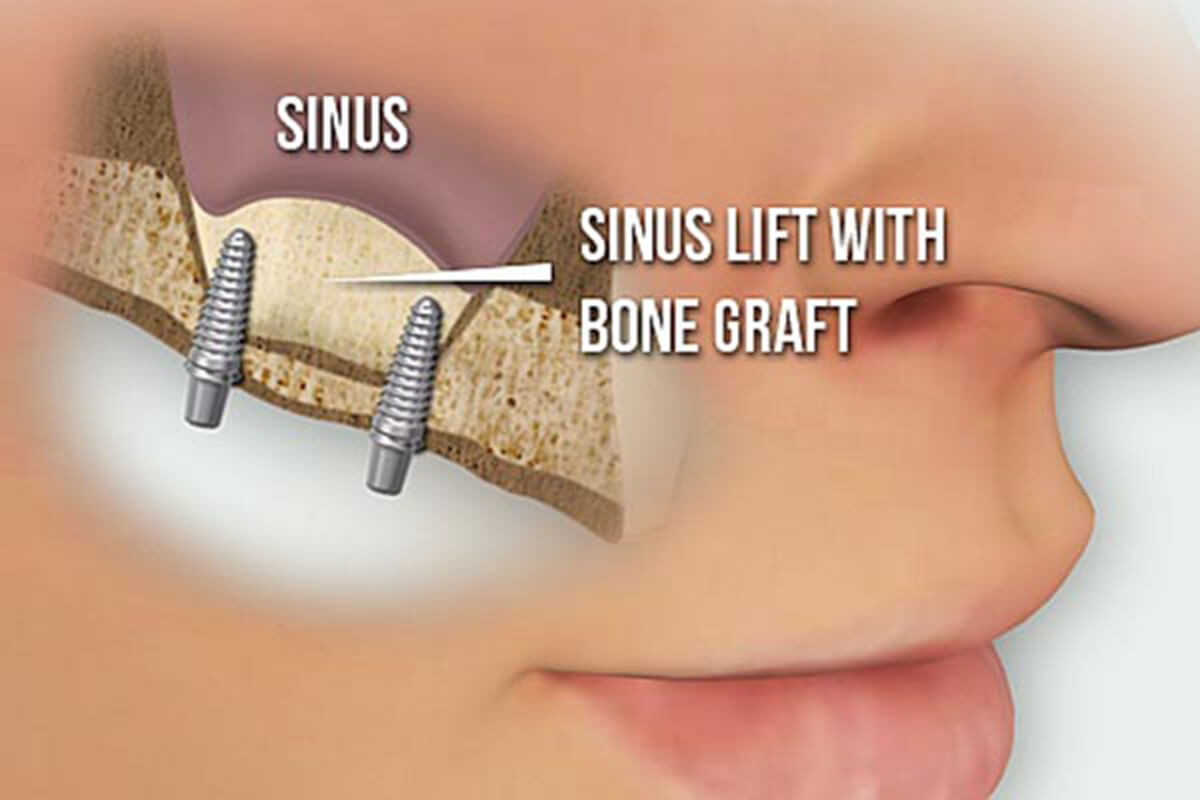 Sinus Lift Vista