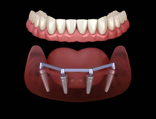 All On 4 Dental Implants Carlsbad