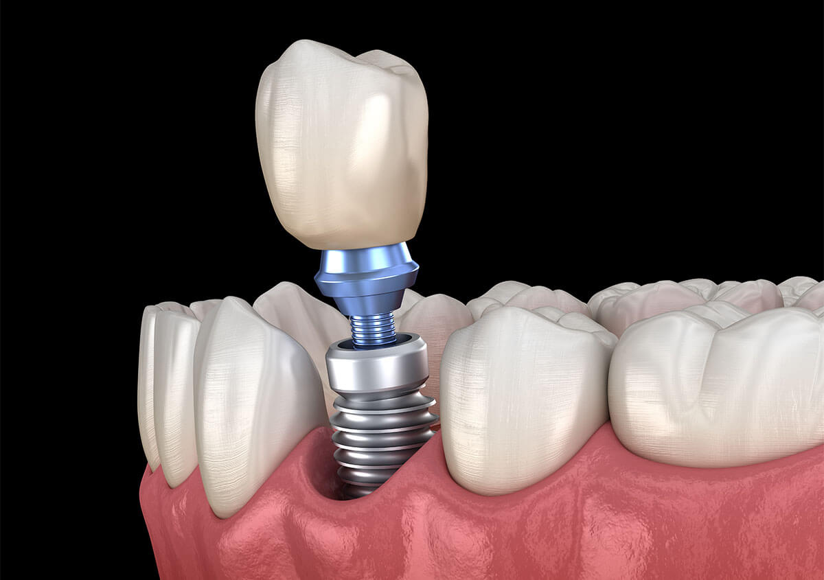 Best Dental Implants Encinitas