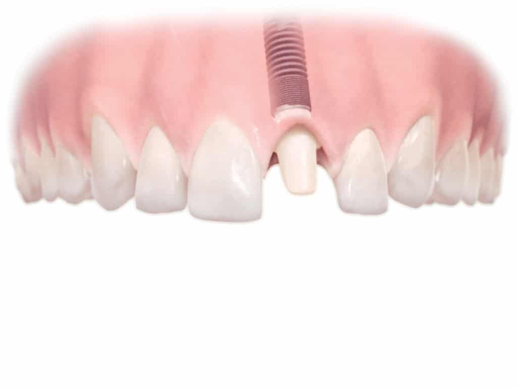 Dental Implants Procedure Oceanside