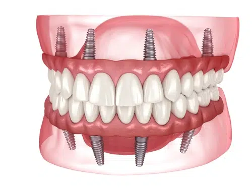 Full Mouth Dental Implants Encinitas