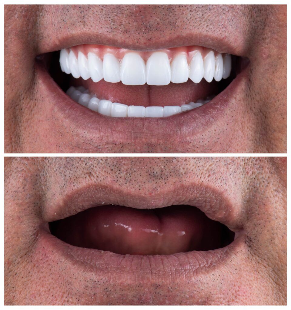 Full Mouth Reconstruction Dental Implants Carlsbad