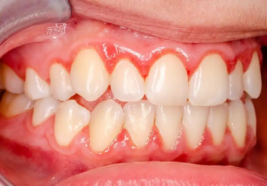 Gingivitis Treatment Encinitas