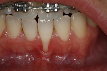 Gum Recession Treatment Encinitas