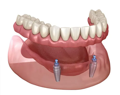 Implant Supported Dentures Vista