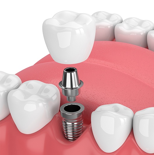 Implant Teeth Procedure Vista