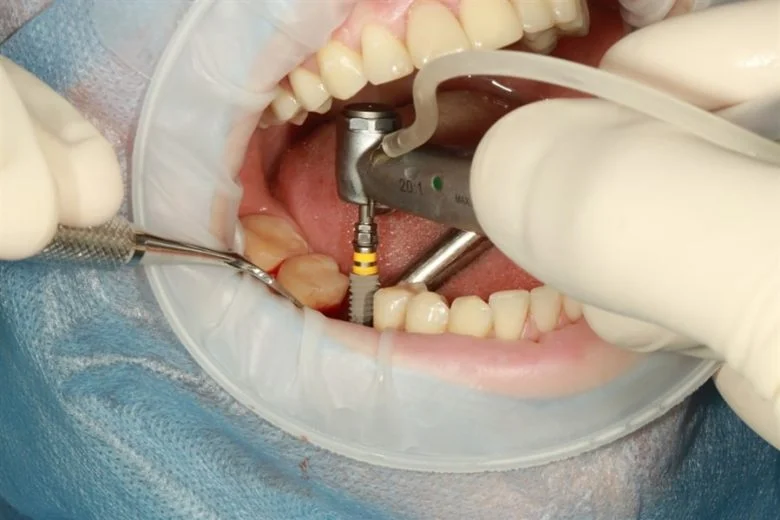 Implant Teeth Surgery Oceanside