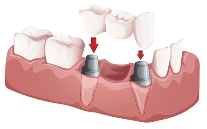 Implant Tooth Bridge Oceanside