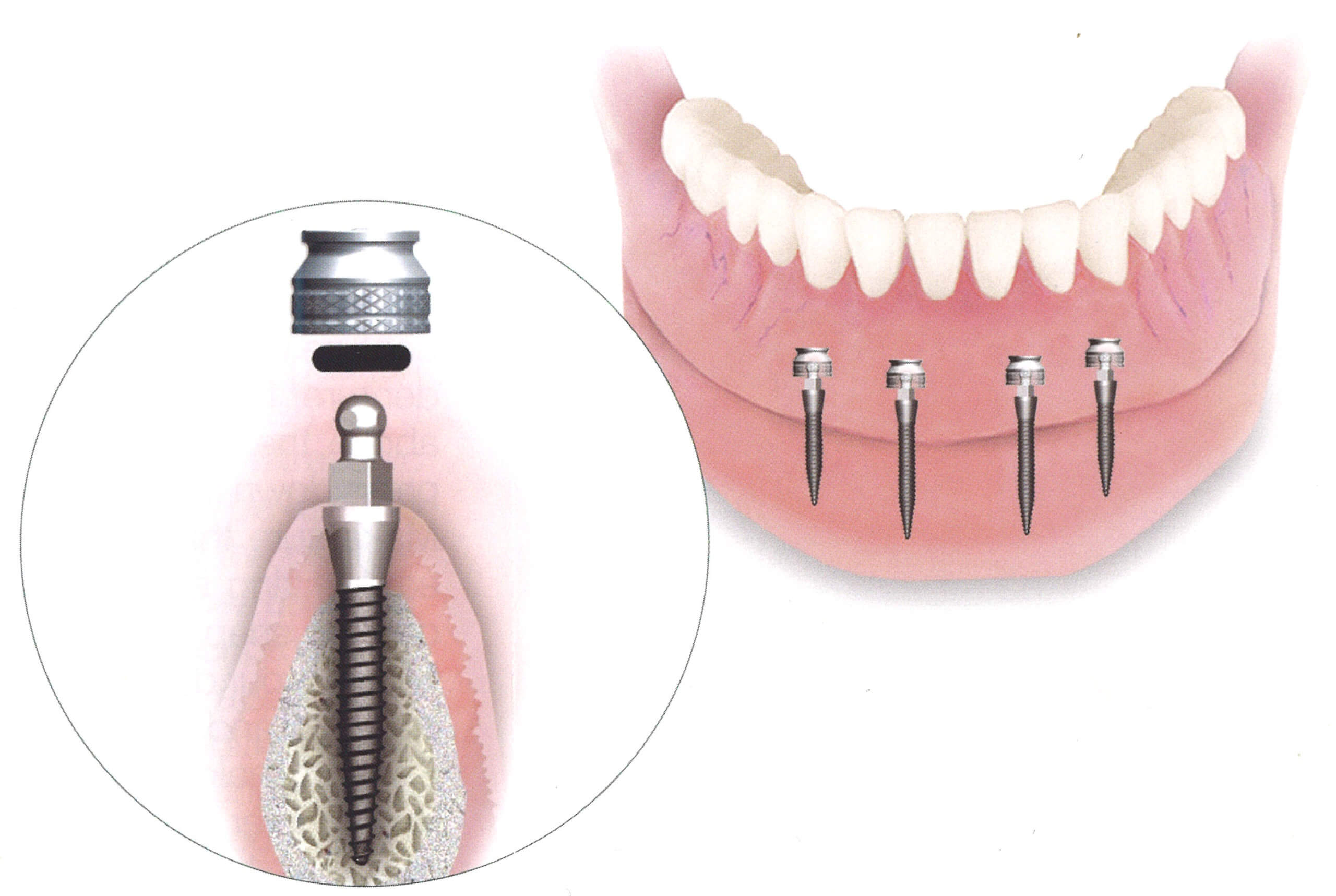 Mini Dental Implants Encinitas