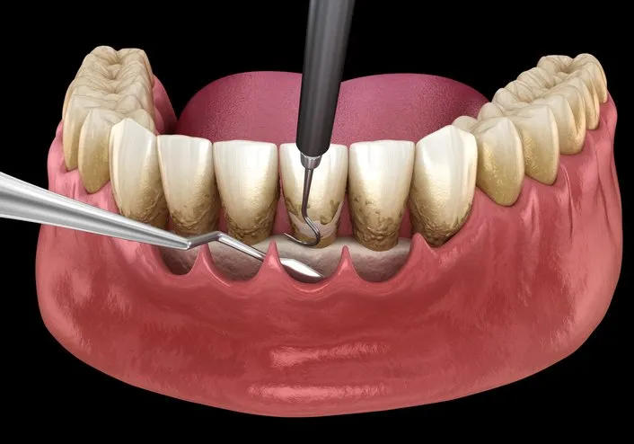 Periodontal Maintenance Carlsbad