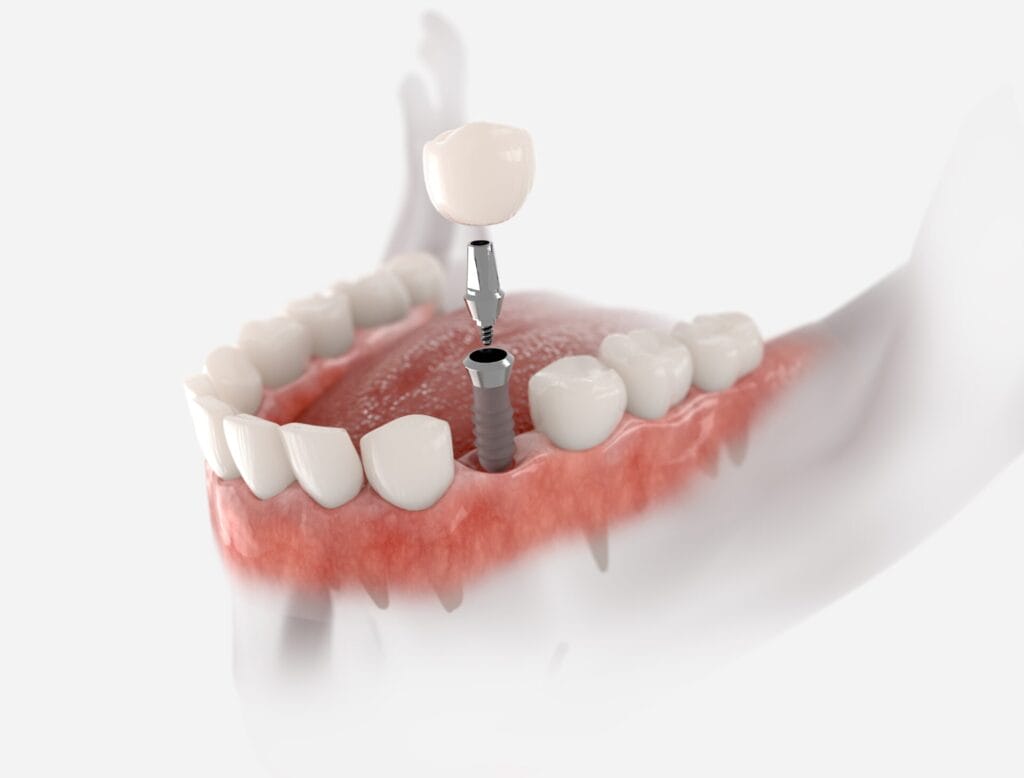 Affordable Dental Implants Encinitas