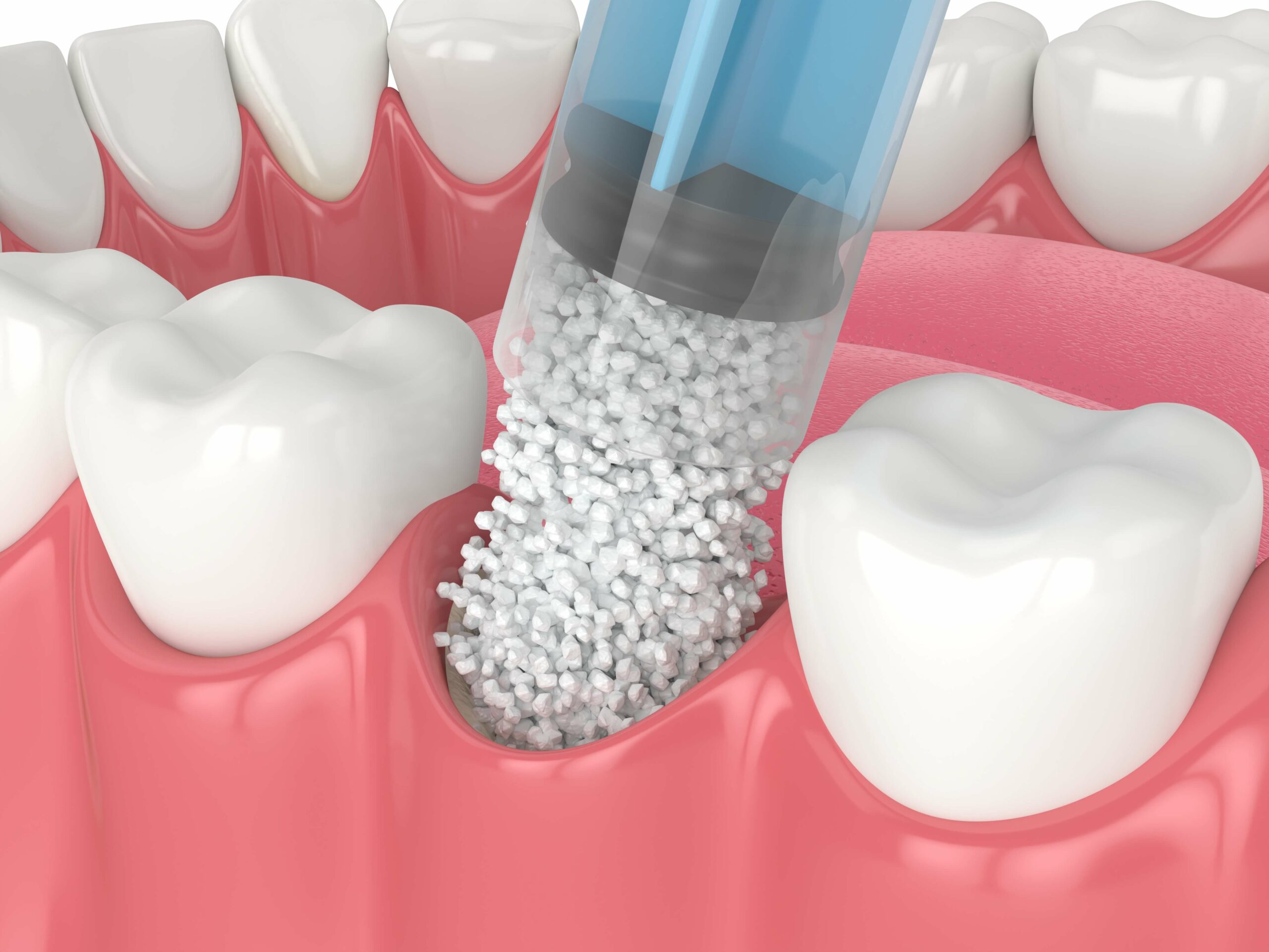 Bone Grafting Oceanside