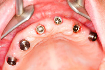 Dental Implant Problems Carlsbad