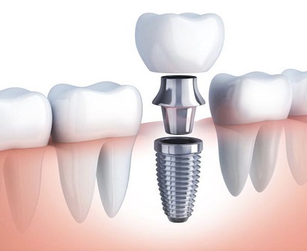 Dental Implants Cost Oceanside