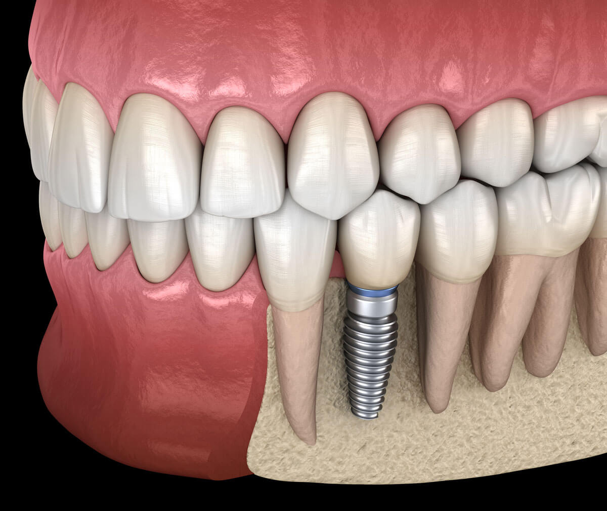 Dental Implants Procedure Vista