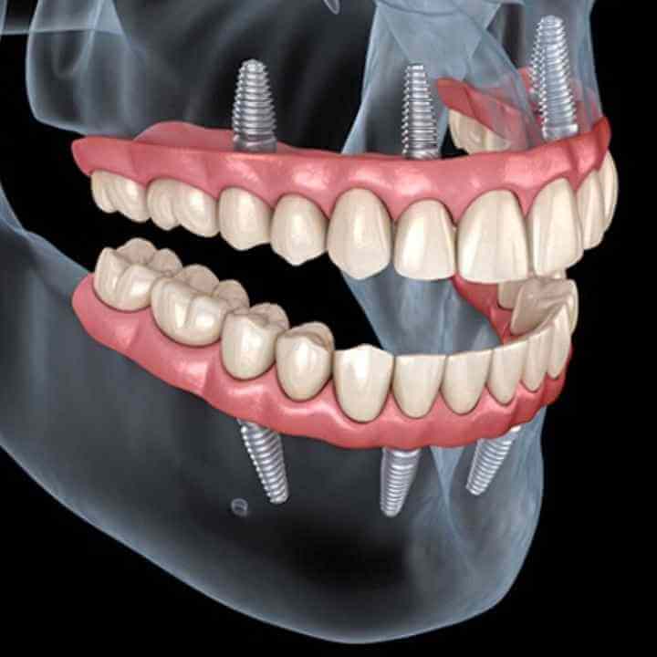 Full Mouth Dental Implants Carlsbad