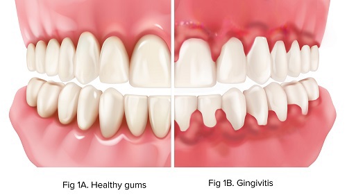 Gum Disease And Receding Gums Carlsbad