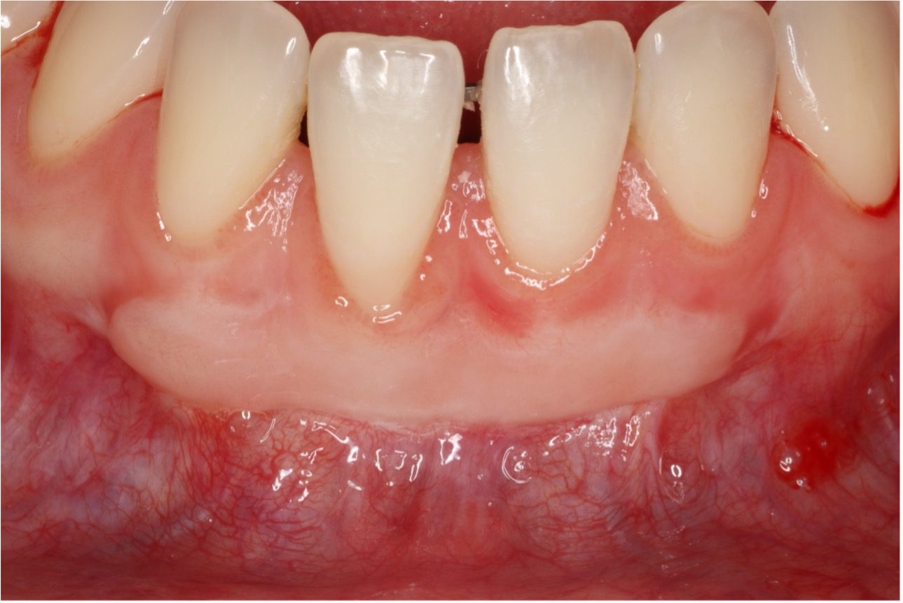 Gum Recession Treatment Carlsbad