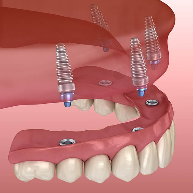 Implant Supported Dentures Encinitas