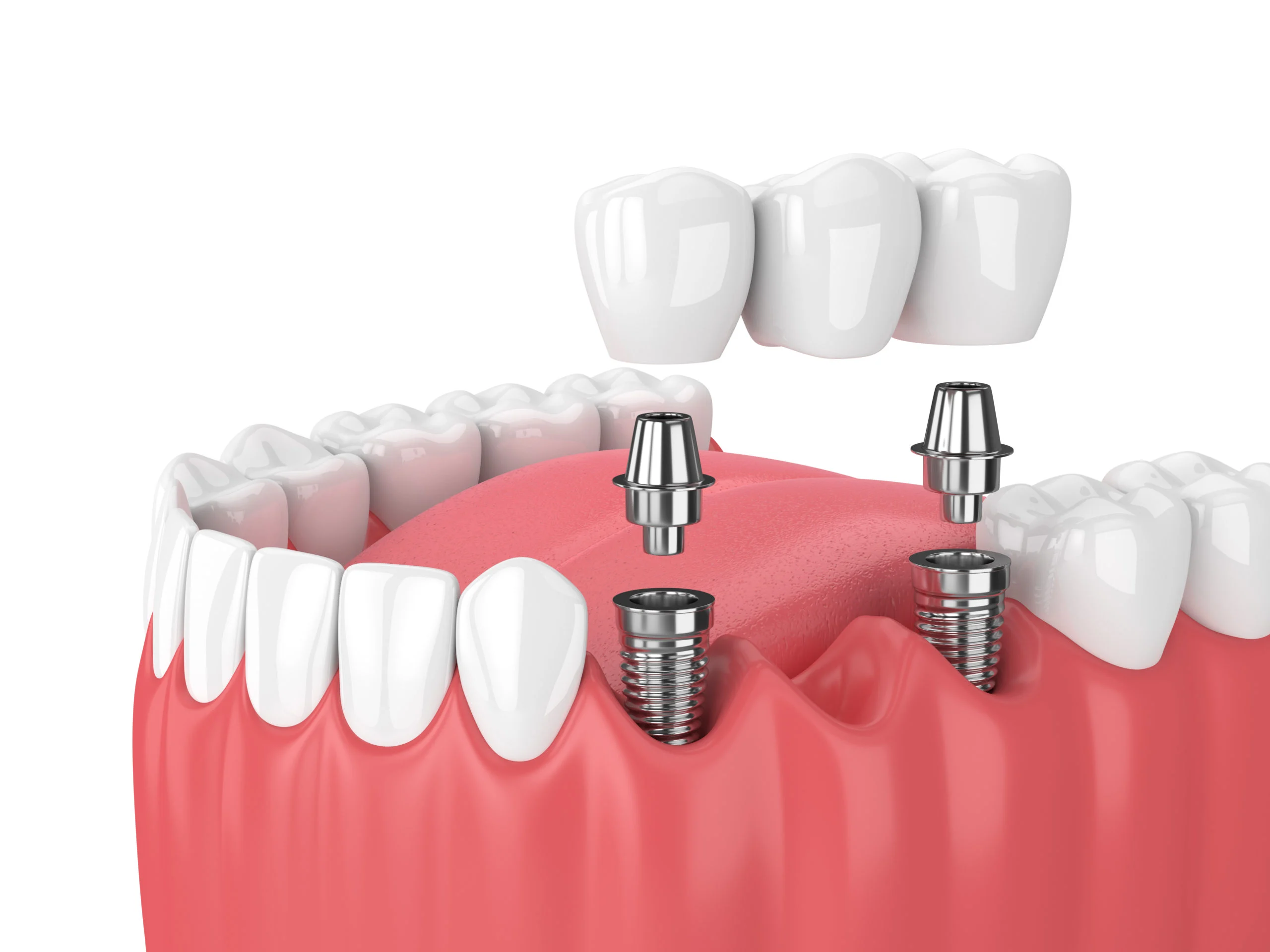 Implant Tooth Bridge Vista