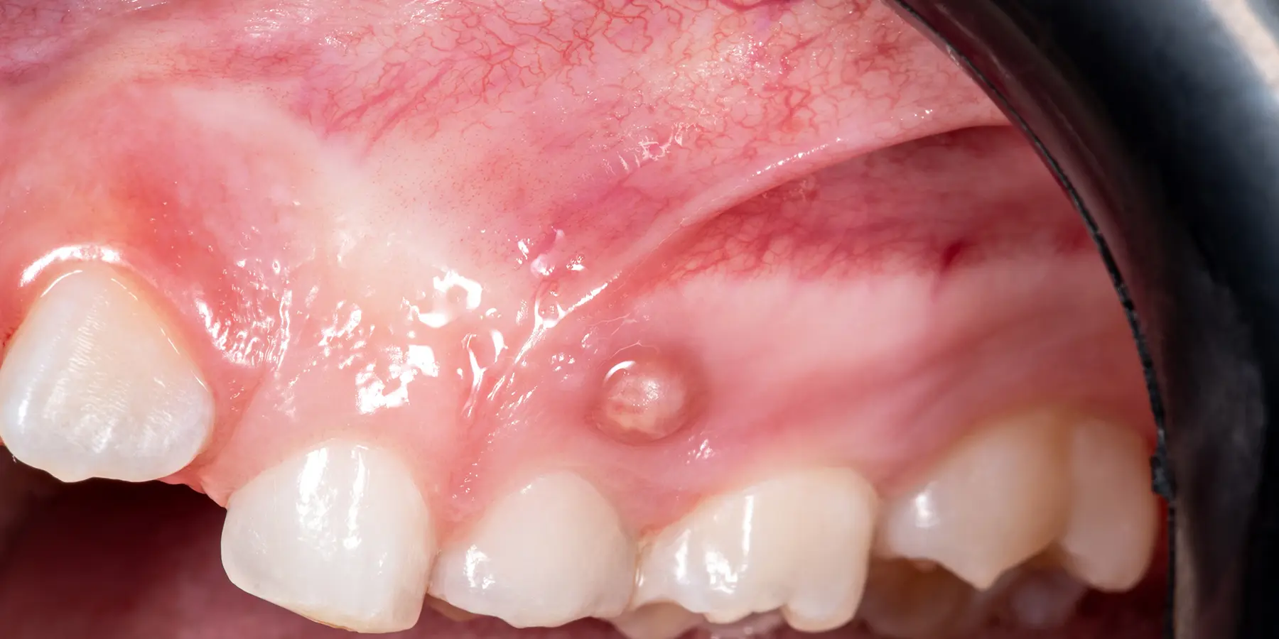 Periodontal Abscess Oceanside