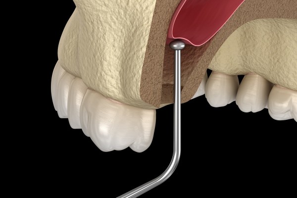 Sinus Lift Encinitas