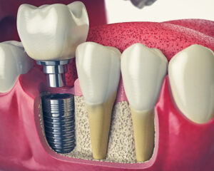 Best Dental Implants Carlsbad